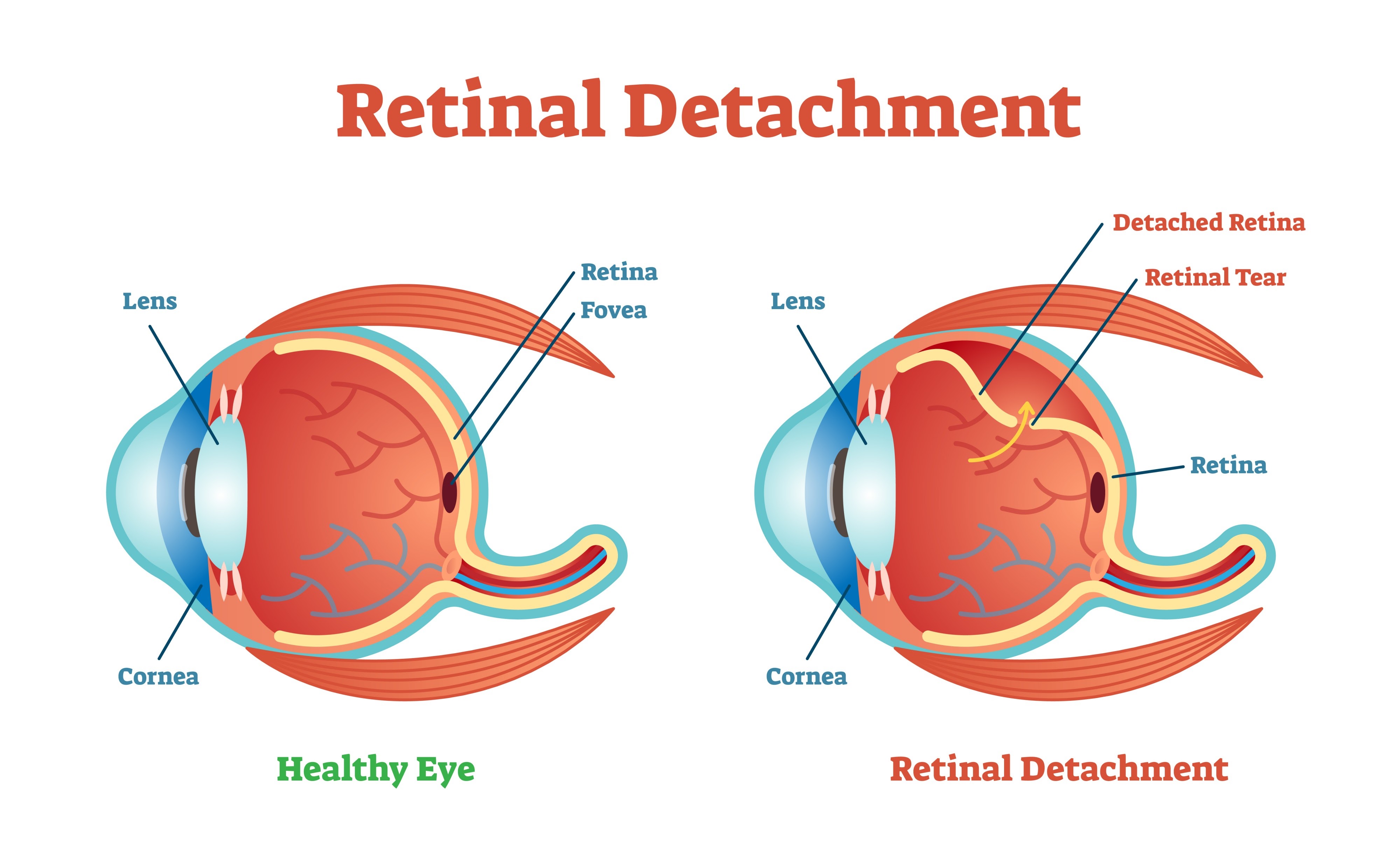 symptoms of retinal detachment vision的图片
