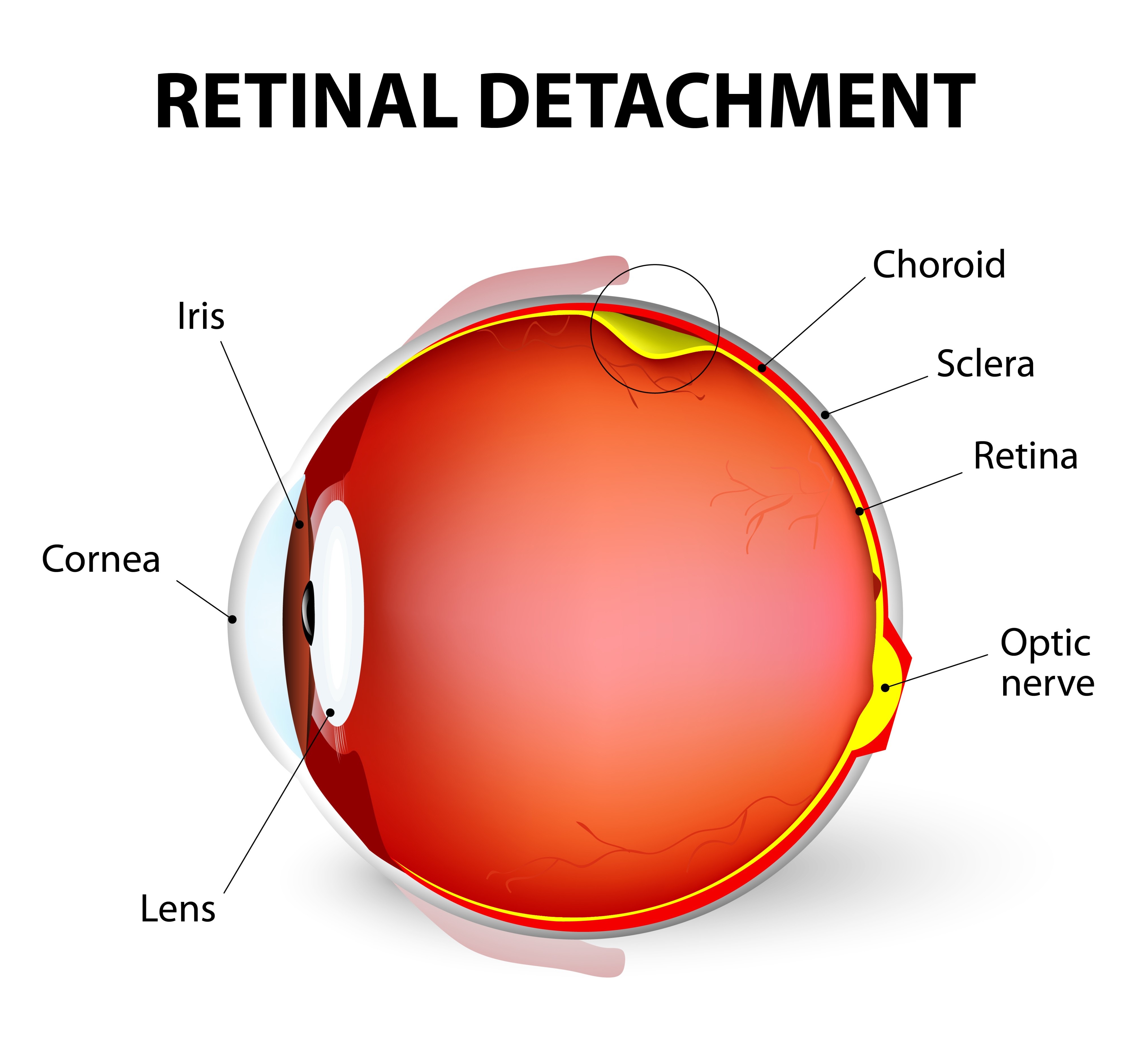 visual field defect retinal detachment的图片
